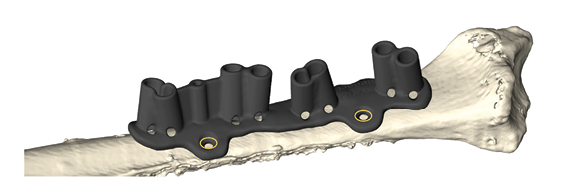 CMX Patient-Specific - Mandible Reconstruction