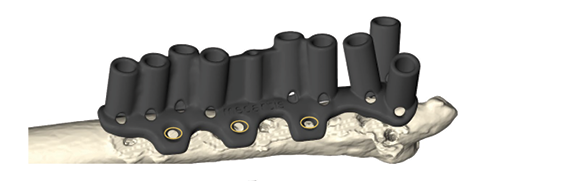 CMX Patient-Specific - Mandible Reconstruction