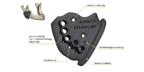CMX Patient-Specific - Mandible Reconstruction