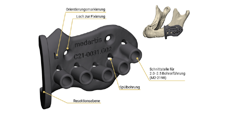CMX Patient-Specific - Mandible Reconstruction